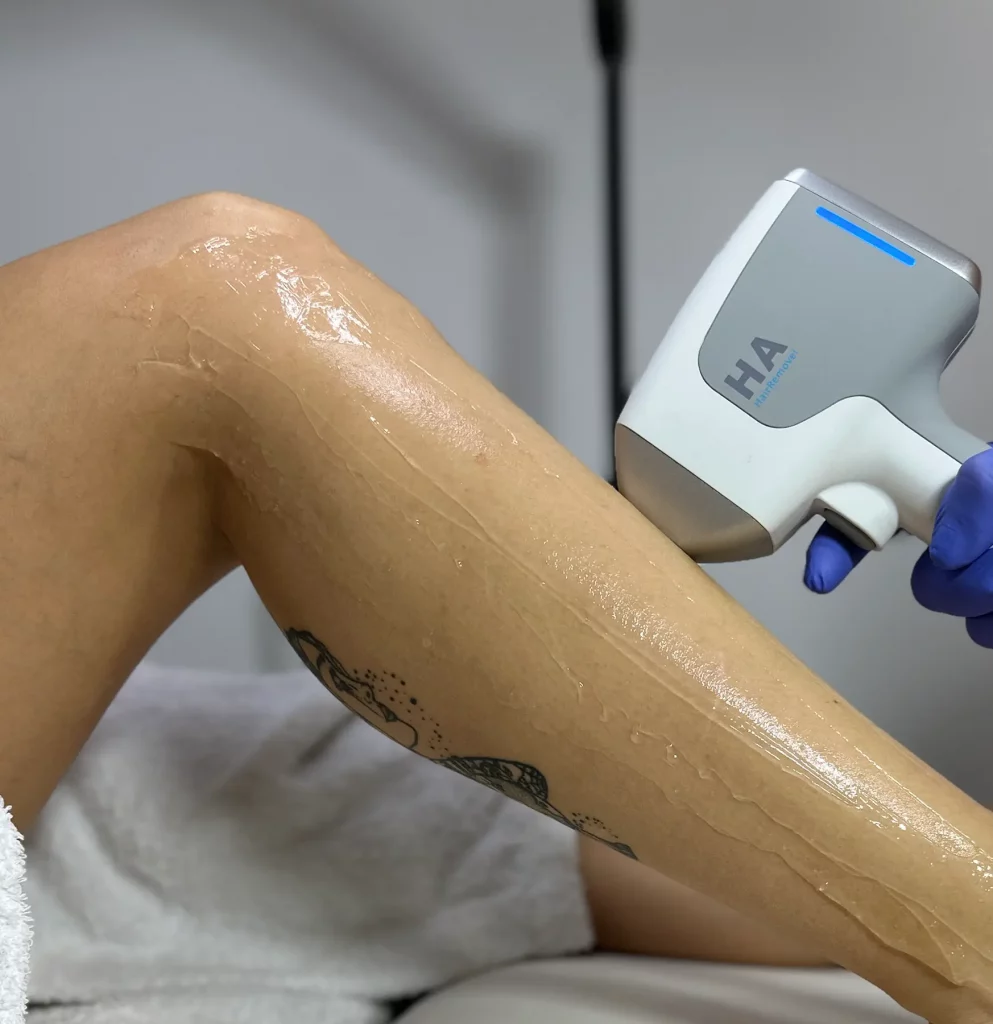 Fotodepilación laser indoloro shr